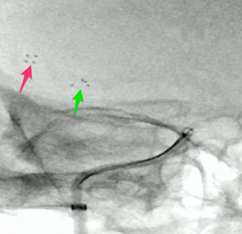 double_stent|400